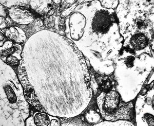 F,24y. | gangliocytoma